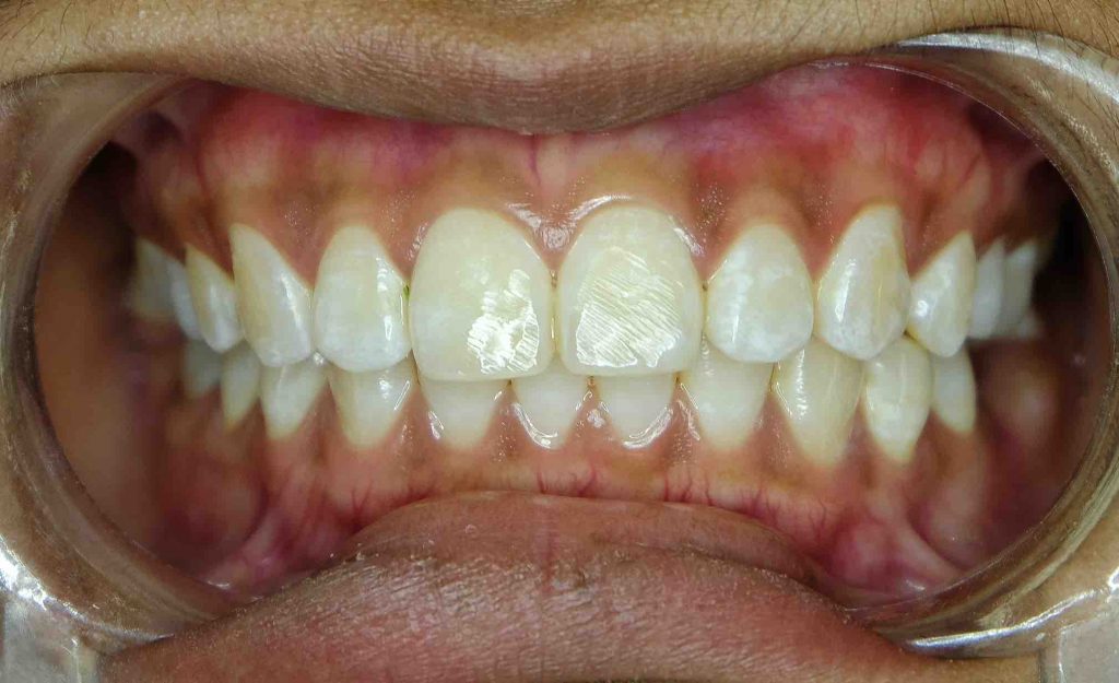 ¿Qué es la fluorosis dental? · Causas y Tratamiento | Vitaldent